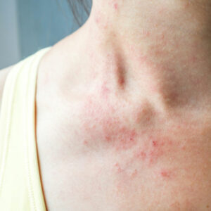 Mycosis fungoides &#8211; more than just a skin rash