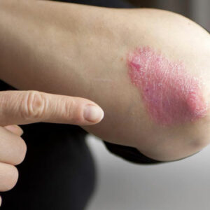 Moderate to severe plaque psoriasis treatment