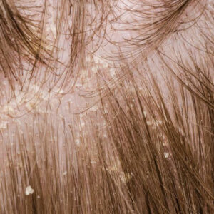 A brief overview of scalp psoriasis