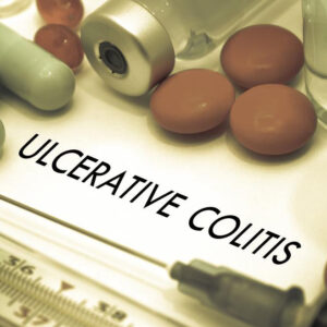 An overview for the treatment of Ulcerative Colitis