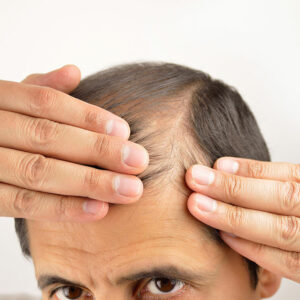 Hair loss – Its symptoms and causes