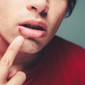 Top 4 FAQs about cold sores