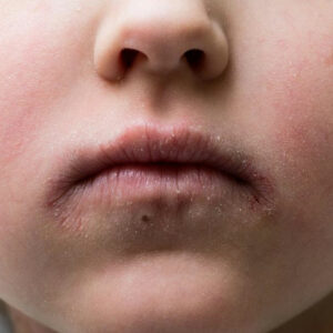 Understanding the causes of impetigo in children and adults