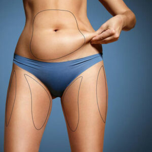 What is coolsculpting fat freezing?