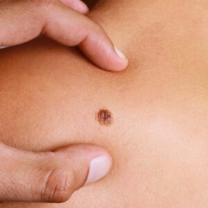 4 common types of melanoma and their treatment options