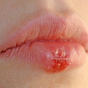 4 effective home remedies for herpes