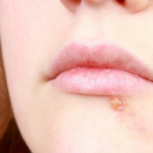 5 useful home remedies to get relief from cold sores