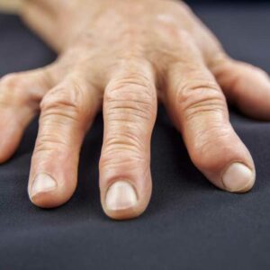 5 Causes of Swollen Fingers