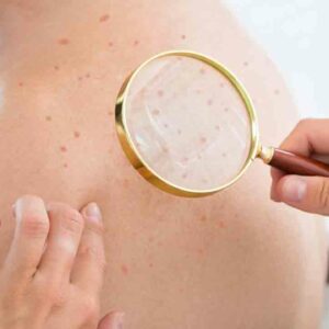 Atopic Dermatitis Eczema &#8211; Causes, Symptoms, and Treatments