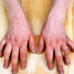 A Brief Overview of Rheumatoid Arthritis