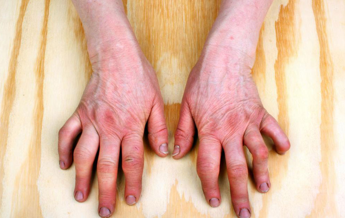 A Brief Overview of Rheumatoid Arthritis