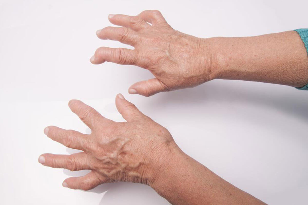 All You Need to Know About the Diagnosis of Rheumatoid Arthritis