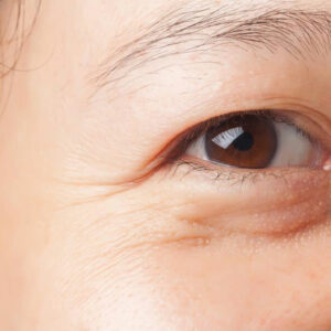 Causes of Under Eye Bags and Their Treatments