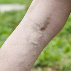 Common Symptoms and Treatments for Varicose Veins