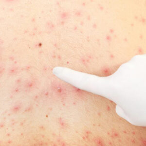 Effective Remedies for Treating Skin Rashes