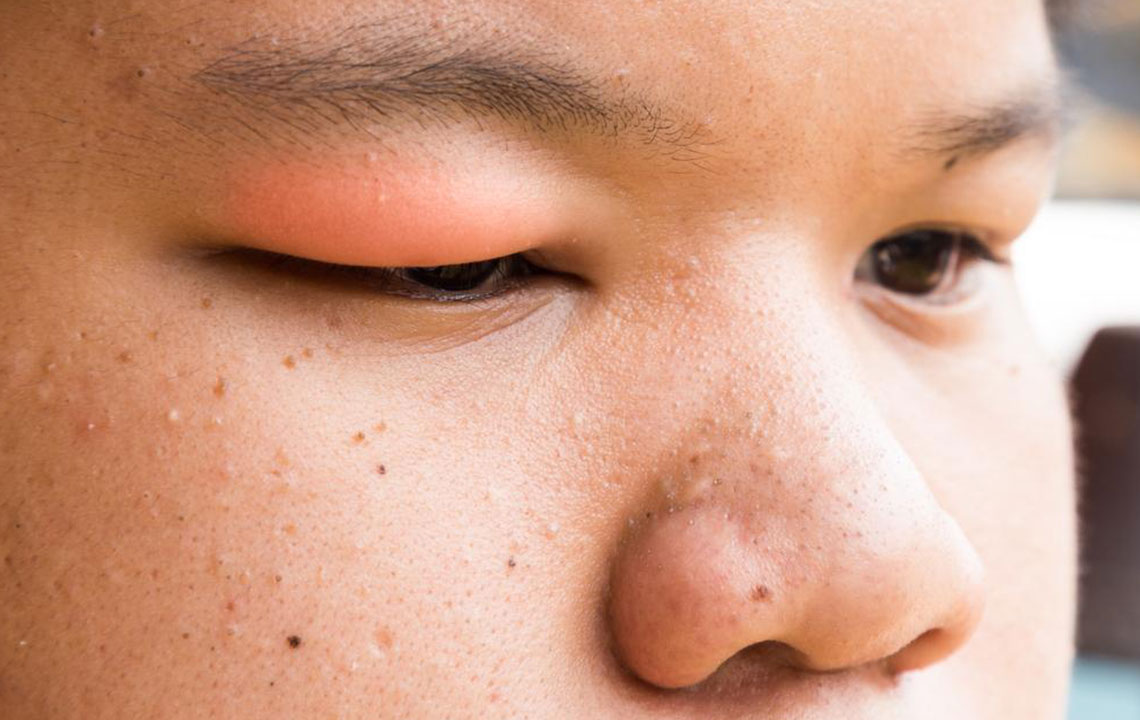 Here&#8217;s How to Get Rid of a Stye With These Simple Steps