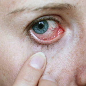 How to Treat Pink Eye with Eye Drops