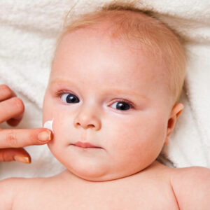 Know More About The Symptoms Causes And Treatment Options For Eczema In Infants