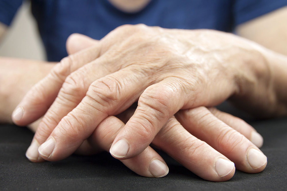 Know about the stages, diagnosis, and prevention of arthritis