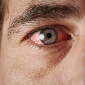 Sjogren’s Syndrome- Causes and Symptoms