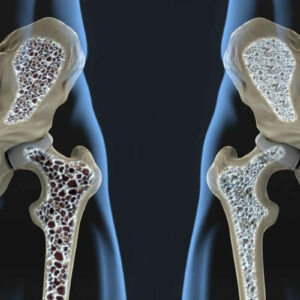 These Common Medical Conditions are Causing Your Osteoporosis Bone Loss