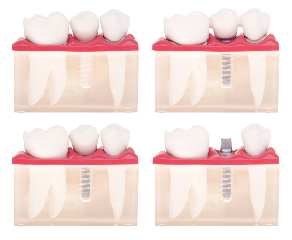 The various types of crowns and caps