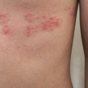 Top 3 Simple Treatments for Shingles You Need to Know