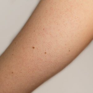 Top Treatment Options for Keratosis Pilaris