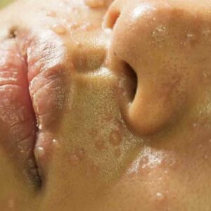 Treat Rosacea With These Natural Medicines and Remedies