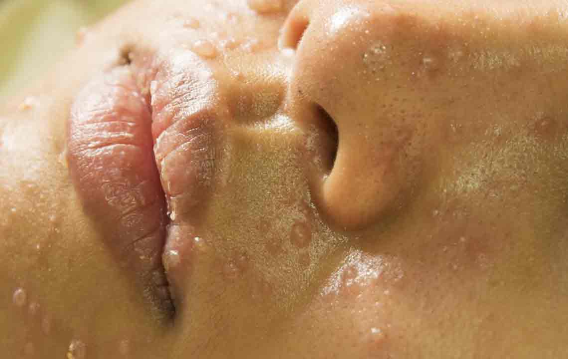 Treat Rosacea With These Natural Medicines and Remedies