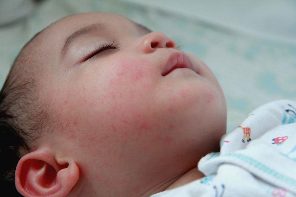 Understanding the Signs and Symptoms of Baby Eczema