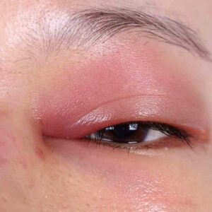 10 ways to fix your under eye puffiness