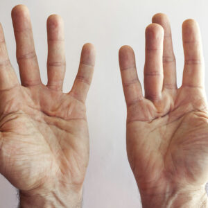 4 hand exercises for Dupuytren&#8217;s contracture patients