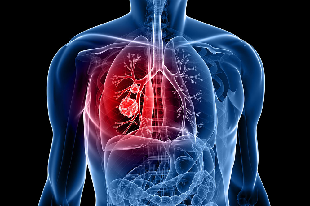 5 cities with the highest rates of lung cancer