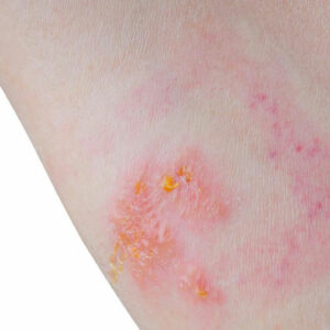 6 Home Remedies for Treating Skin Rashes